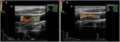 High-Frame Rate Vector Flow Imaging Technique: Initial Application in Evaluating the Hemodynamic Changes of Carotid Stenosis Caused by Atherosclerosis